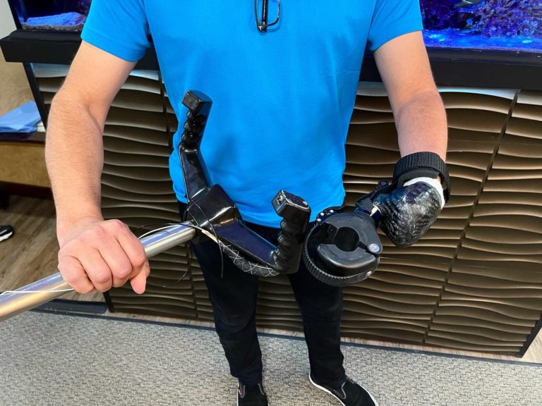 » Partial Hand Prosthesis Innovative Prosthetic Solutions, Inc.